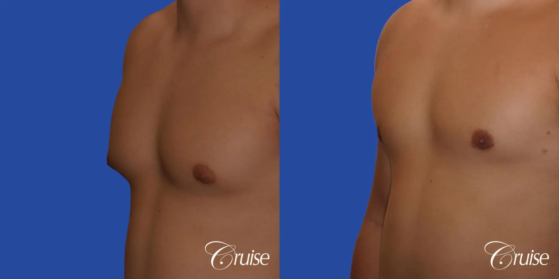 mild gynecomastia with puffy nipple and areola incision - Before and After 2