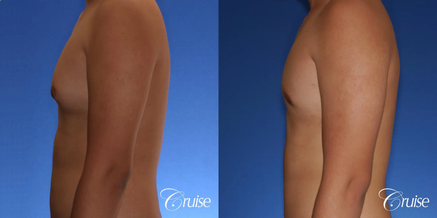 best gynecomastia surgery with plastic surgeon, Dr. Cruise - Before and After 2