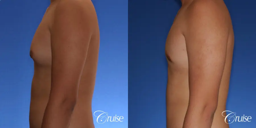best gynecomastia surgery with plastic surgeon, Dr. Cruise - Before and After 2