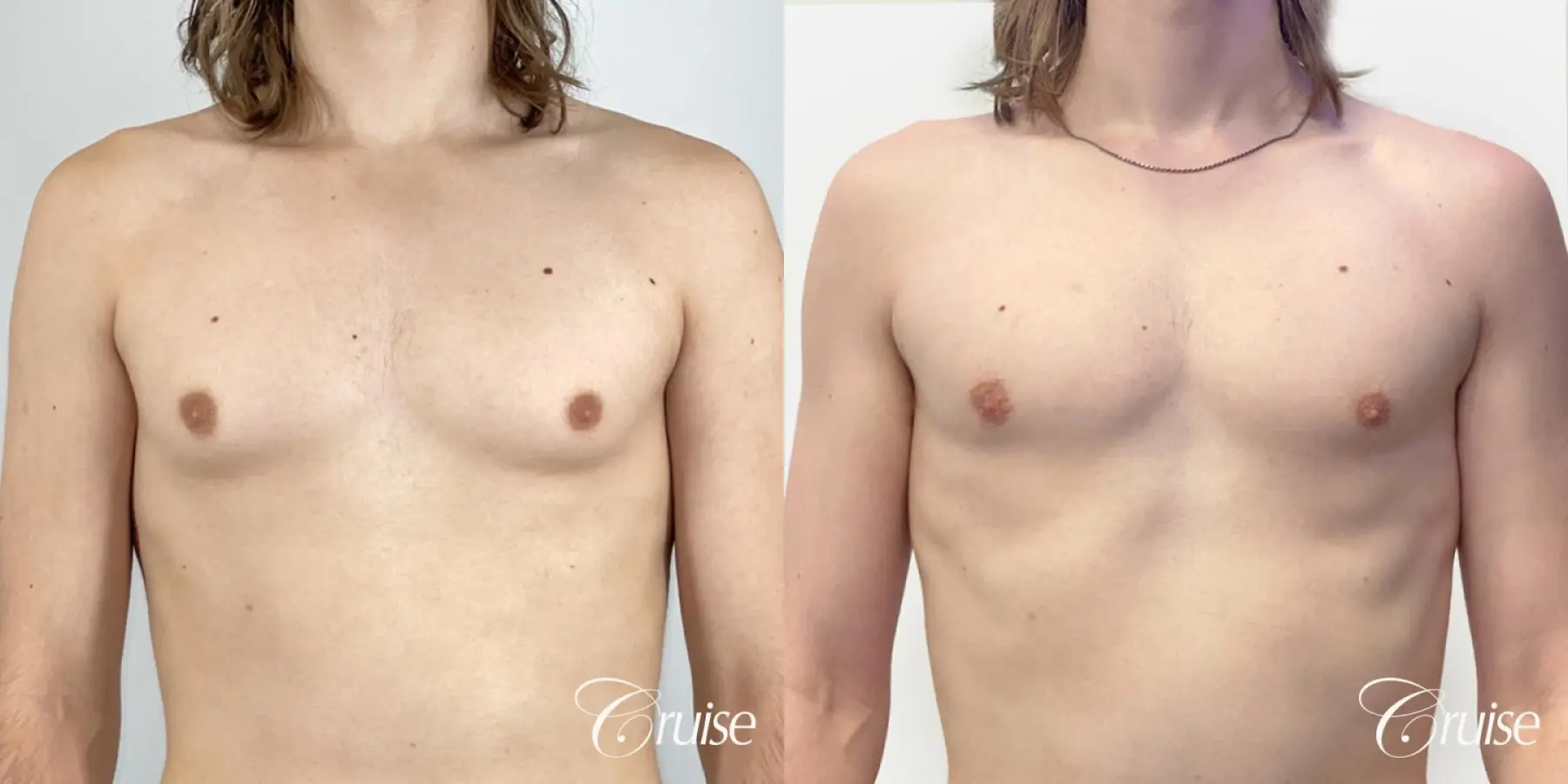 Type 1 Gynecomastia Removal - Before and After 1