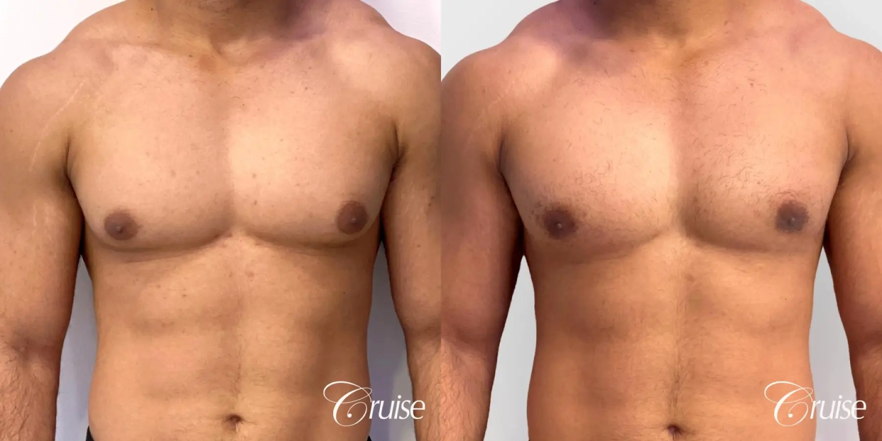 Type 1 Gynecomastia with Puffy Nipples - Before and After