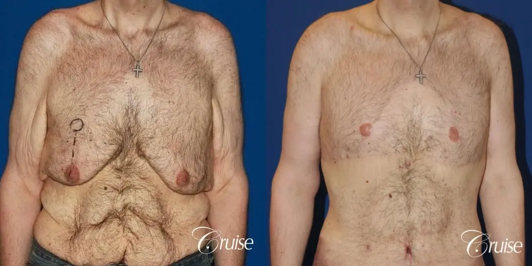 severe weight loss gynecomastia upper body lift - Before and After 1