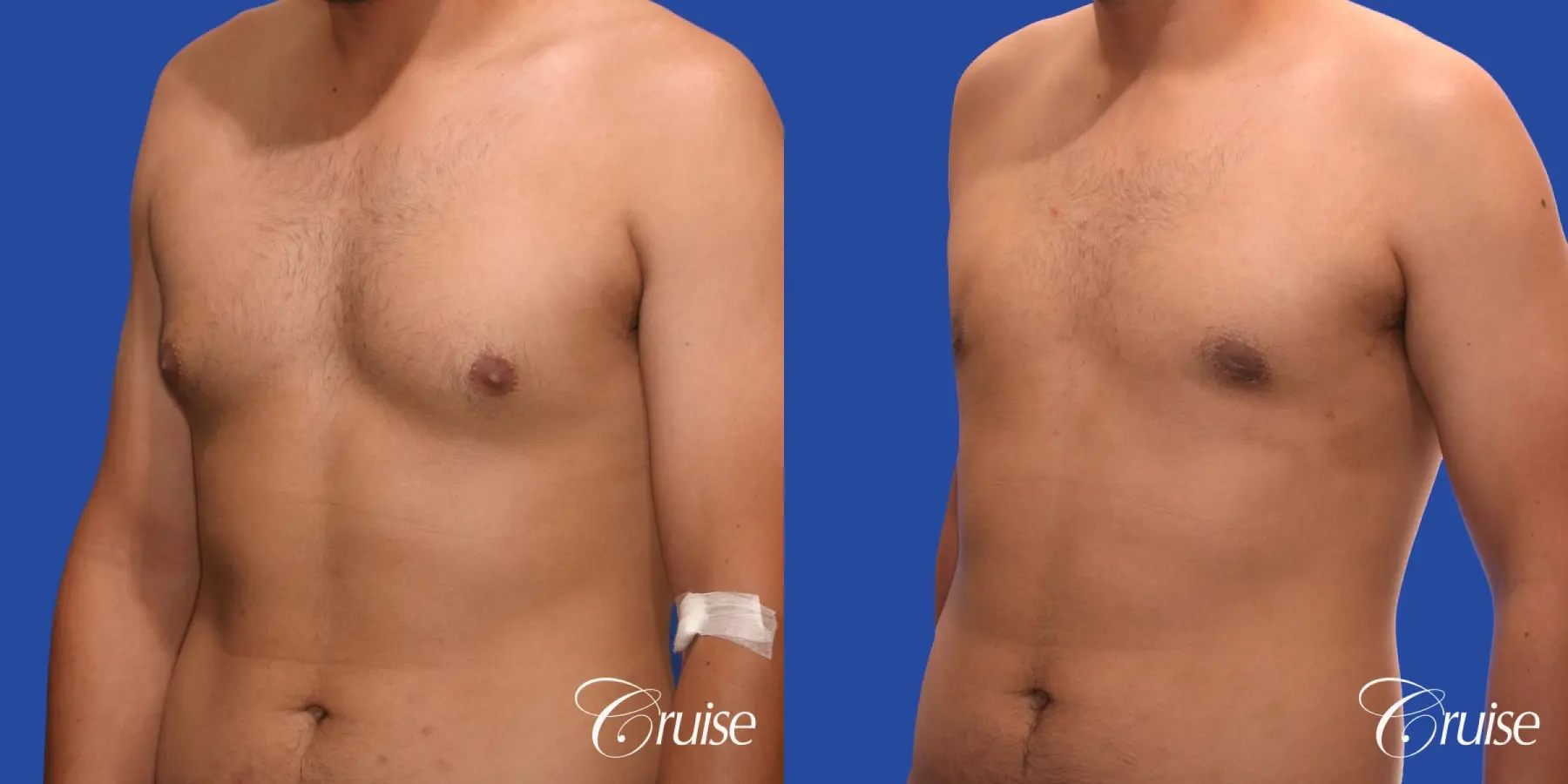 mild gynecomastia standard PA areola incision - Before and After 3