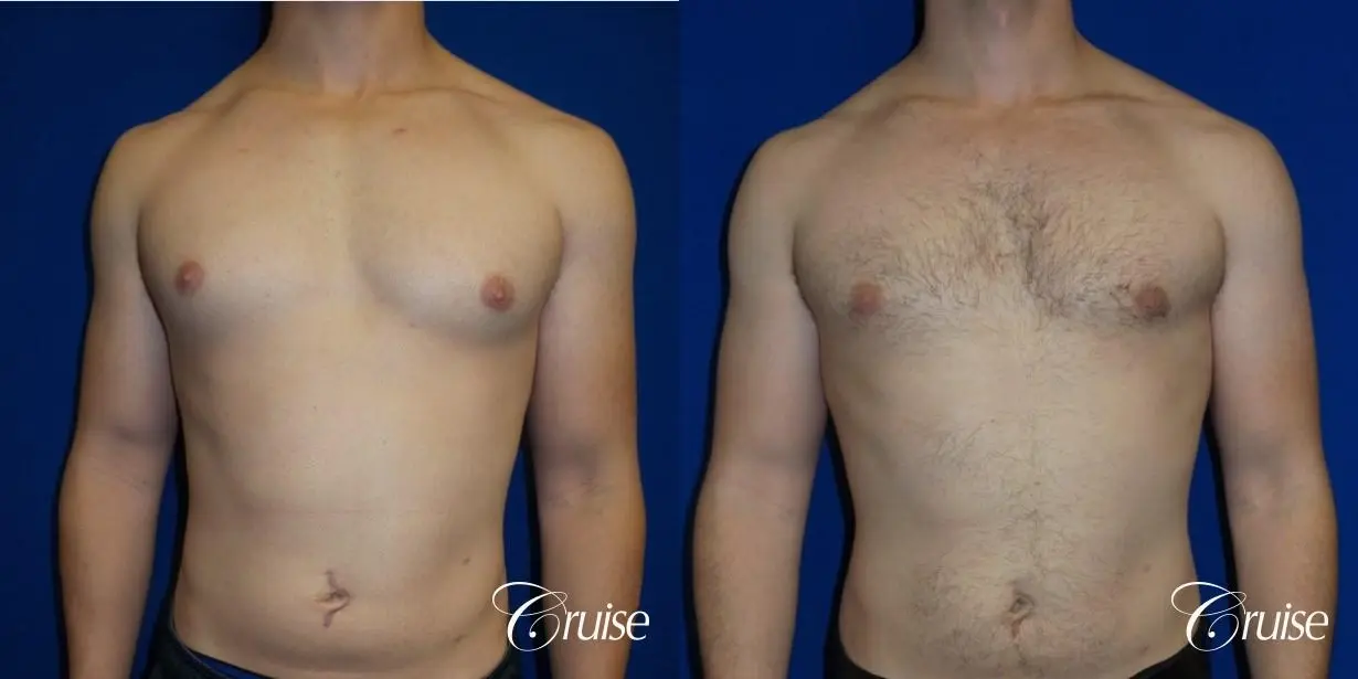Adult gynecomastia before and after photos - Before and After 1