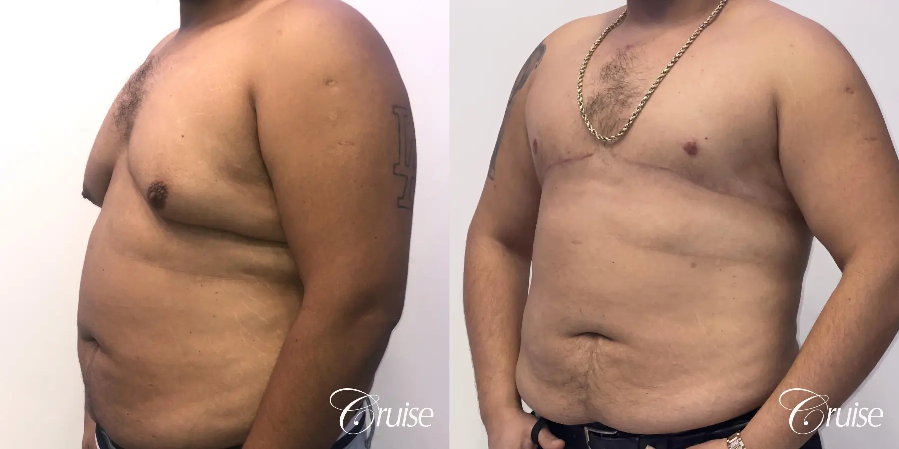 Gynecomastia: Patient 133 - Before and After 3