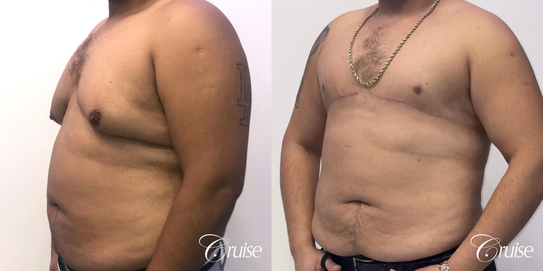 Gynecomastia: Patient 135 - Before and After 3