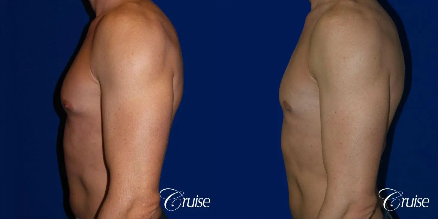 Type 1.5 Puffy Nipple Gynecomastia - Before and After 3
