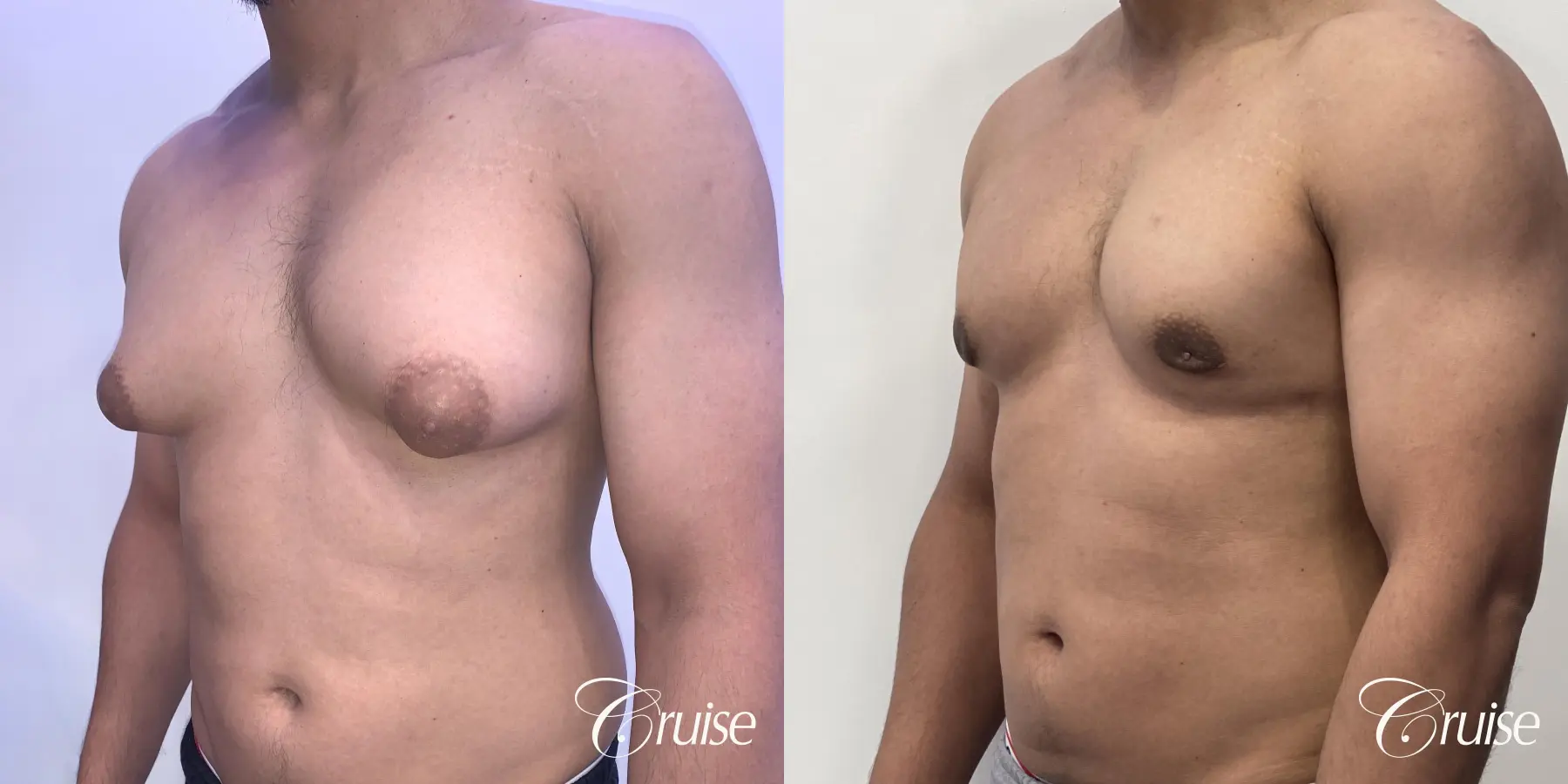 gynecomastia surgery - Before and After 3