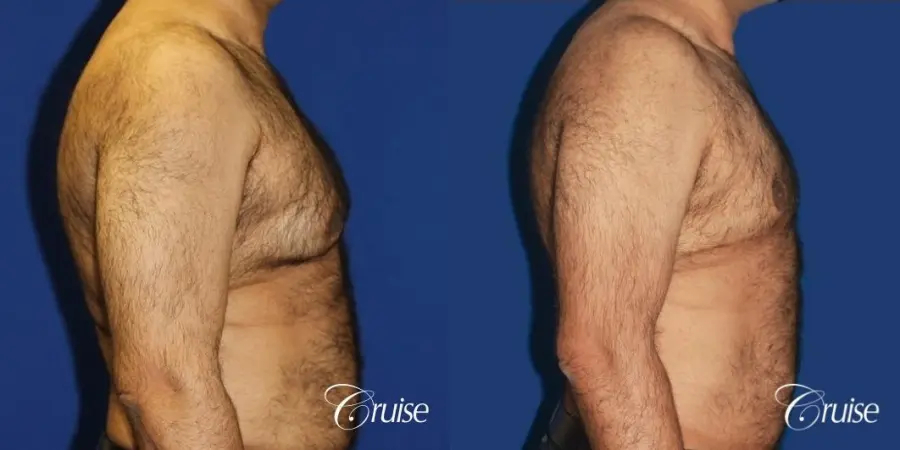 40 year old with severe gynecomastia results - Before and After 3