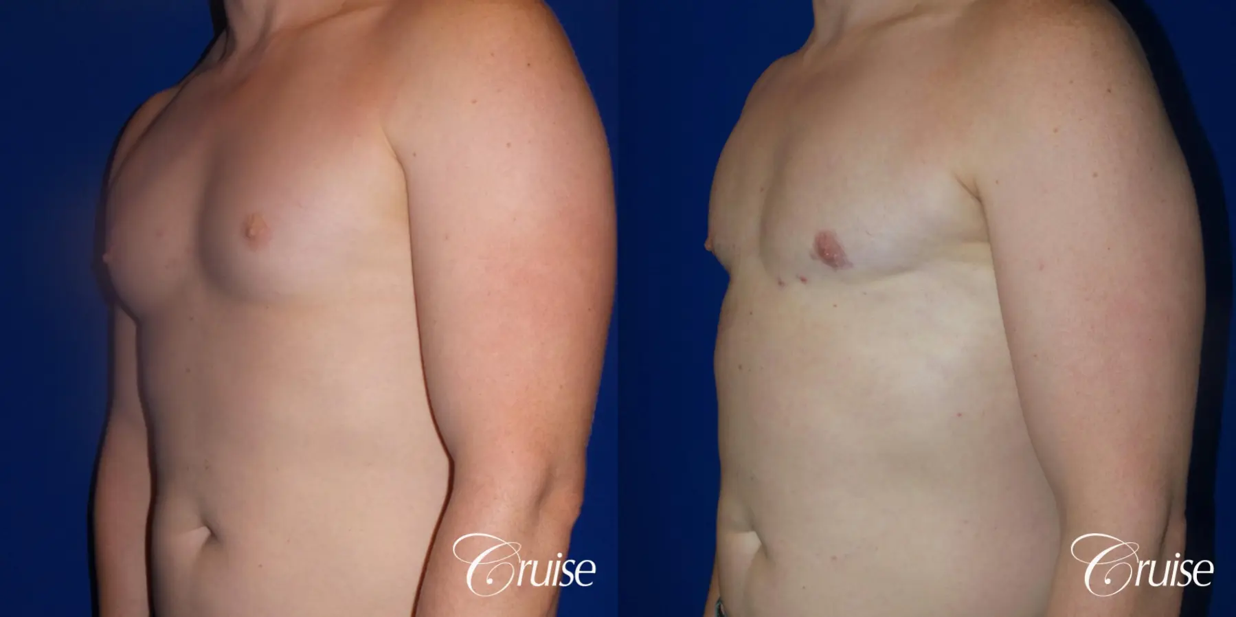 Gynecomastia: Patient 148 - Before and After 3