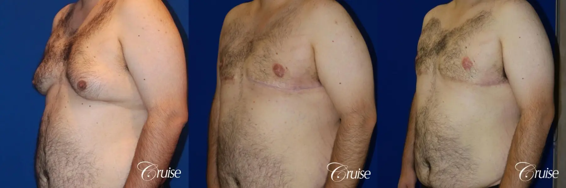 gynecomastia with free nipple graft - Before and After 2