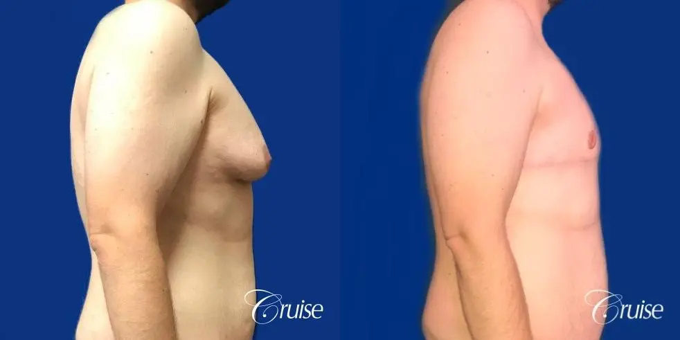 Pedicle incision Dr. Cruise Newport Beach CA - Before and After 4