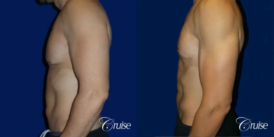 Type 3 Skin Laxity Gynecomastia with Nipple Elevation - Before and After 2