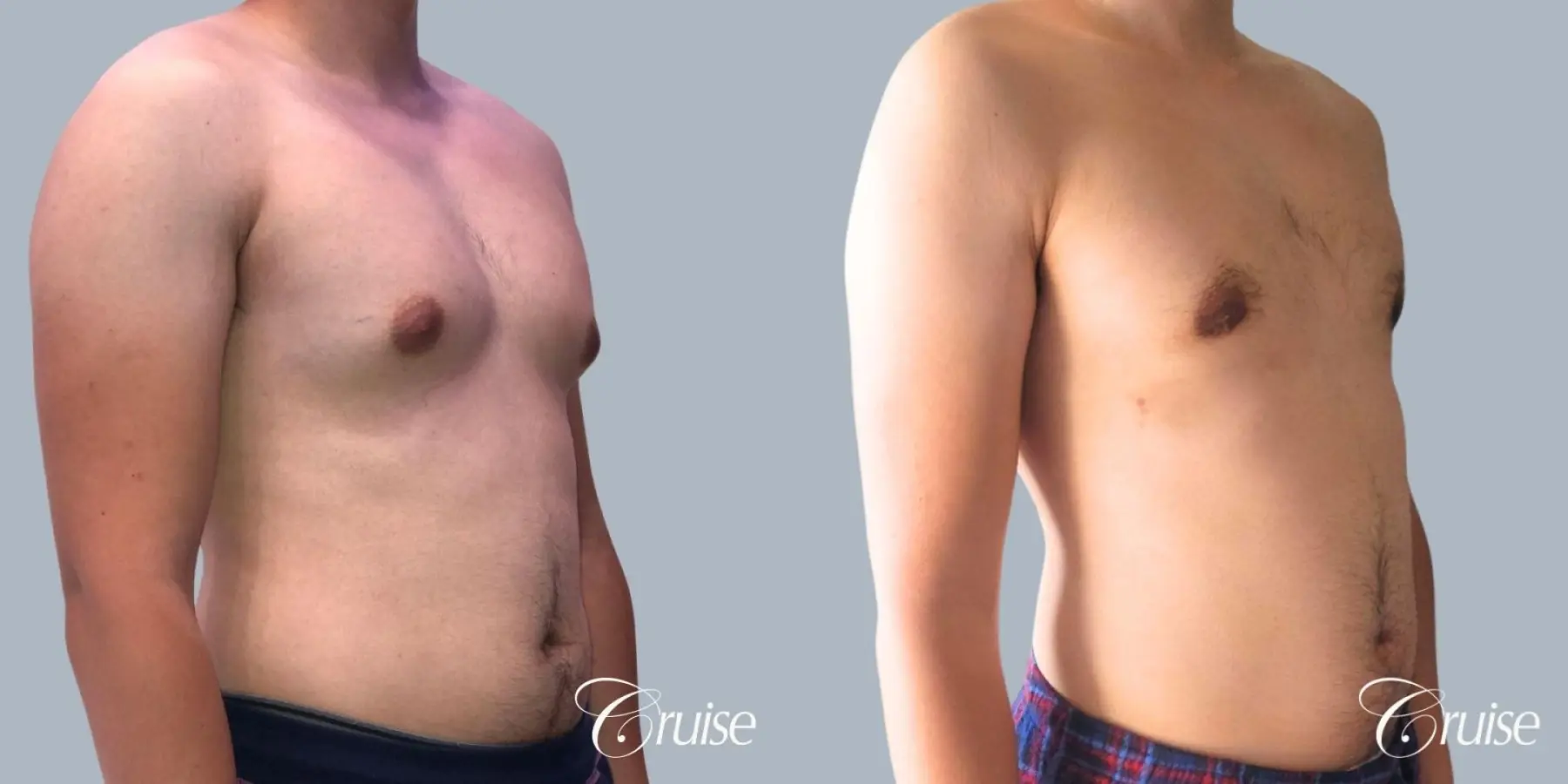 Gynecomastia: Patient 155 - Before and After 2