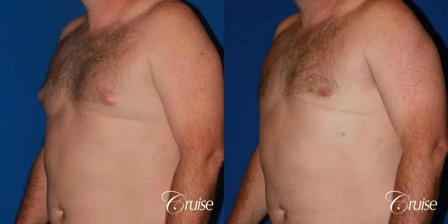 mild puffy nipple on 42 year old - Before and After 3