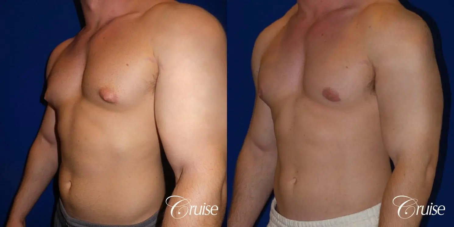 Pictures of young bodybuilder with puffy nipples - Before and After 2