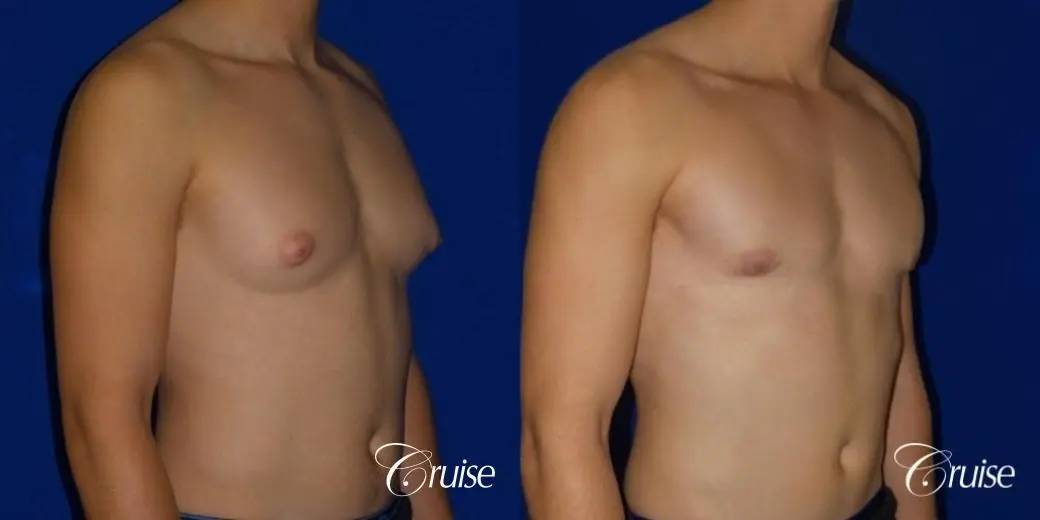 teenage gynecomastia before and afters - Before and After 2