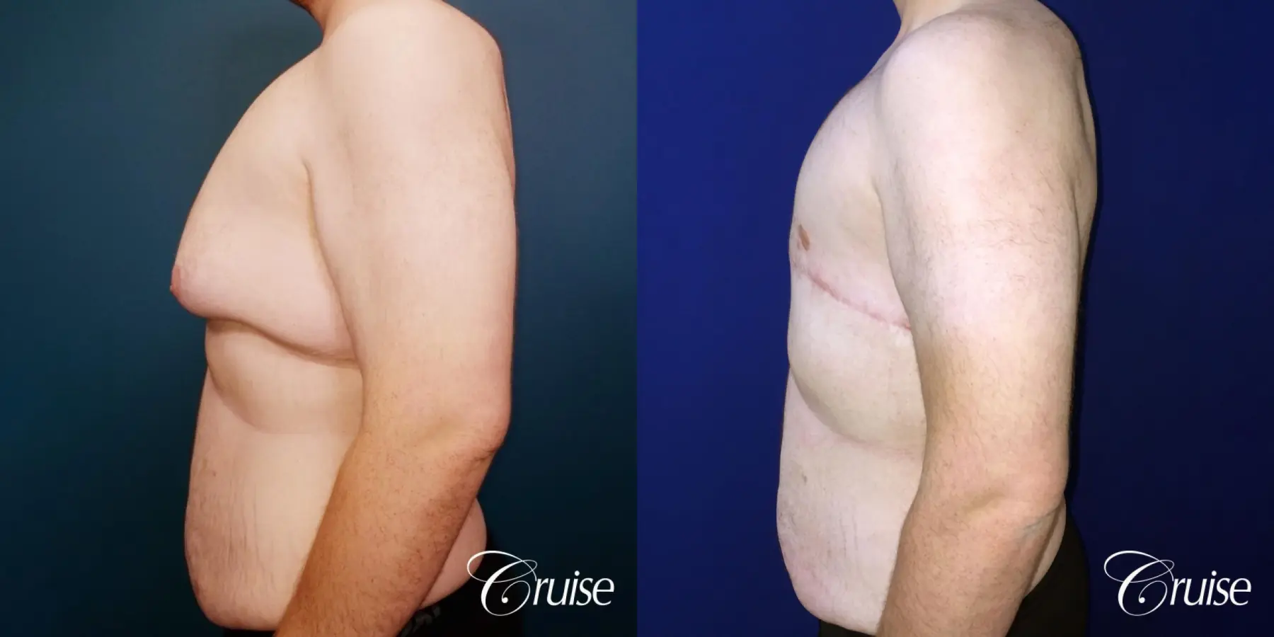 severe gynecomastia - Before and After 4