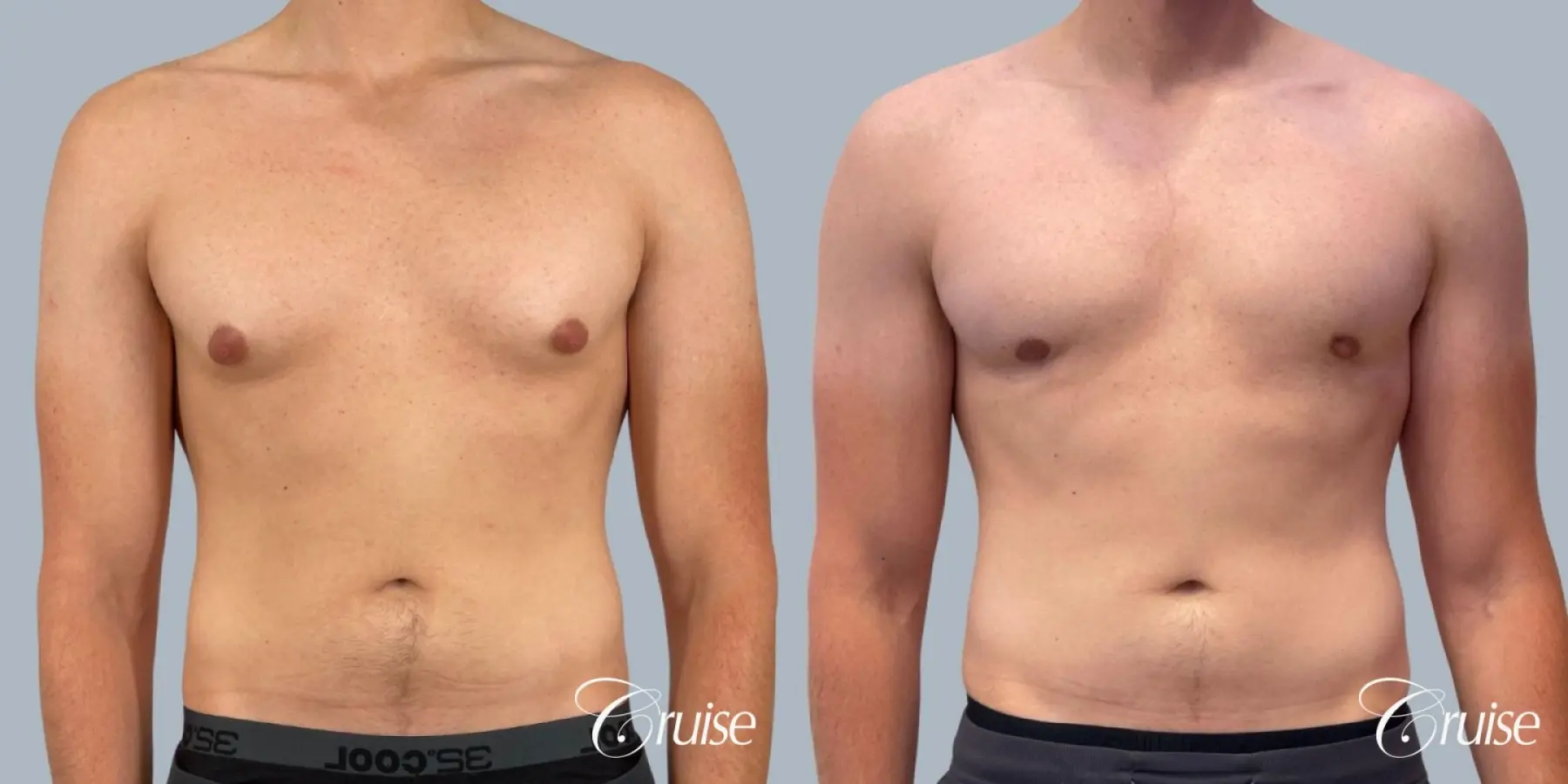 Gynecomastia: Patient 155 - Before and After 1