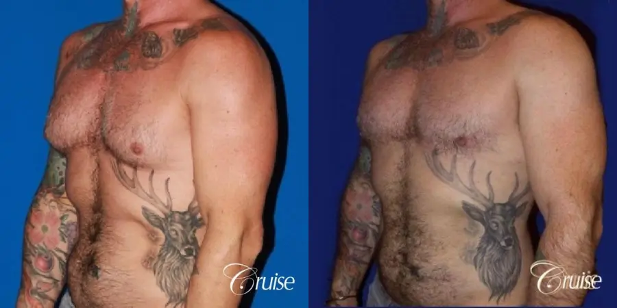 adult gynecomastia - Before and After 4