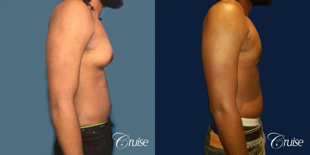 Type 3 Gynecomastia Gland Removal & Skin Tightening - Before and After 2