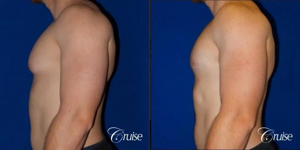 Dr. Cruise gynecomastia surgery photos - Before and After 5