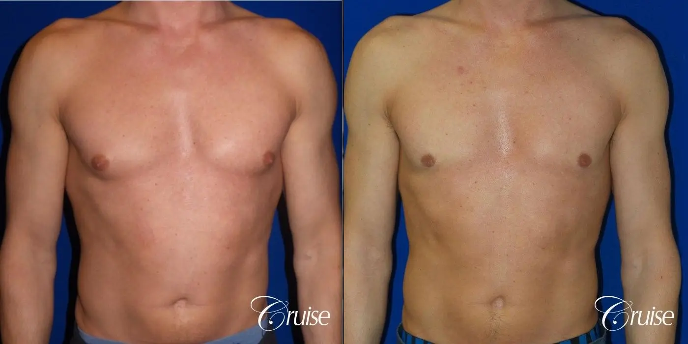 Type 1.5 Puffy Nipple Gynecomastia - Before and After  