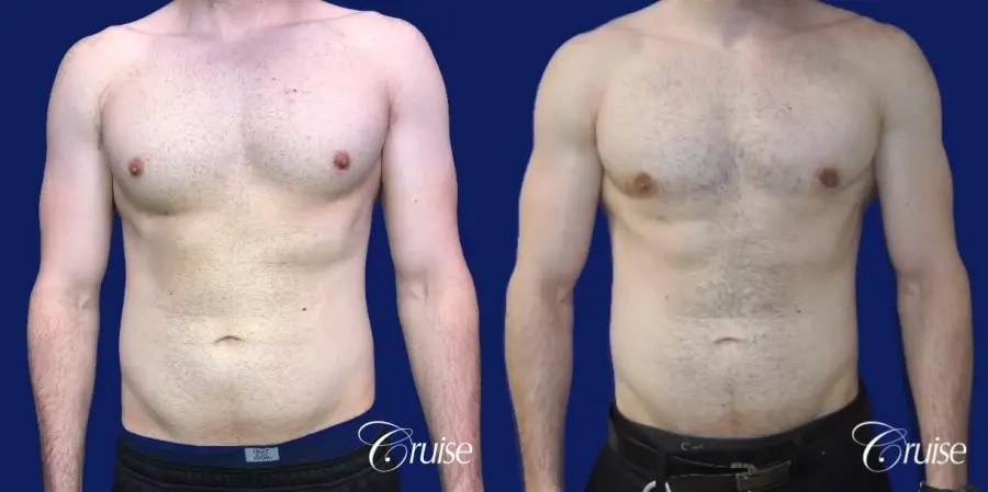 Moderate Gynecomastia -Areola Incision - Before and After 1