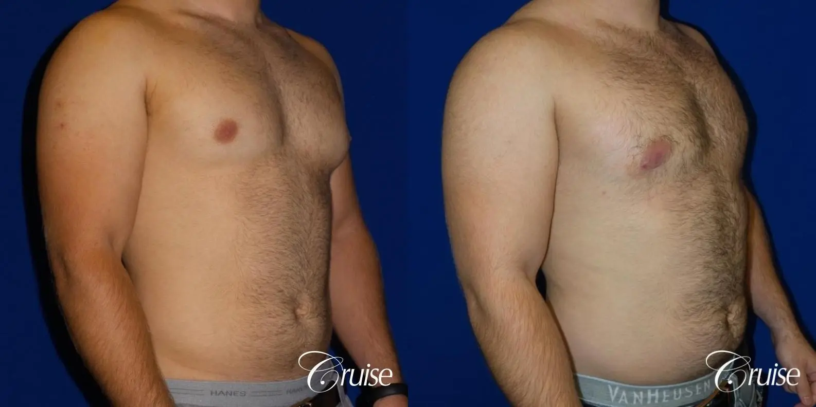best gynecomastia results - Before and After 4