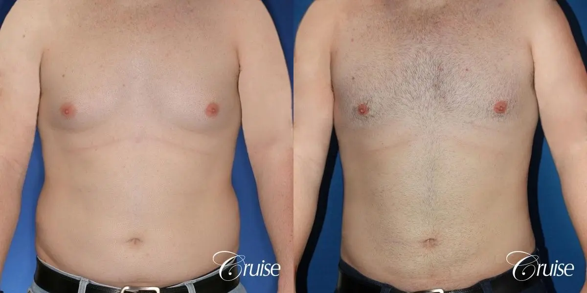 moderate chest gynecomastia and liposuction flanks - Before and After 1