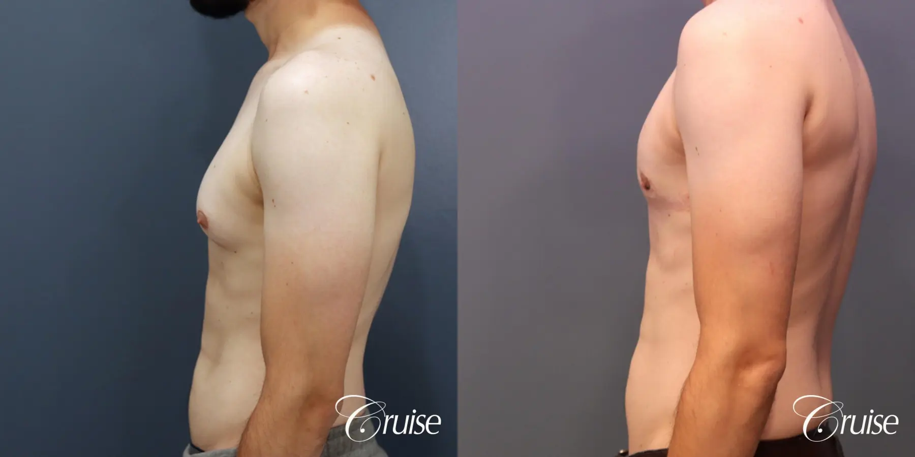 Gynecomastia: Patient 140 - Before and After 3