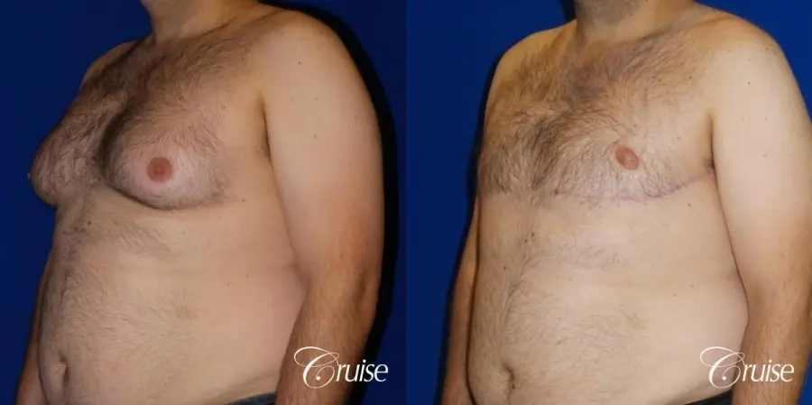 severe gynecomastia surgery - Before and After 2