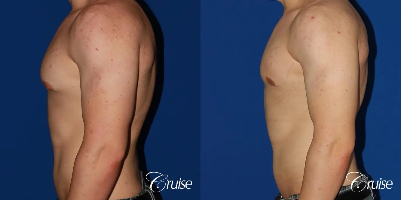 mild-gynecomastia-revision - Before and After 2