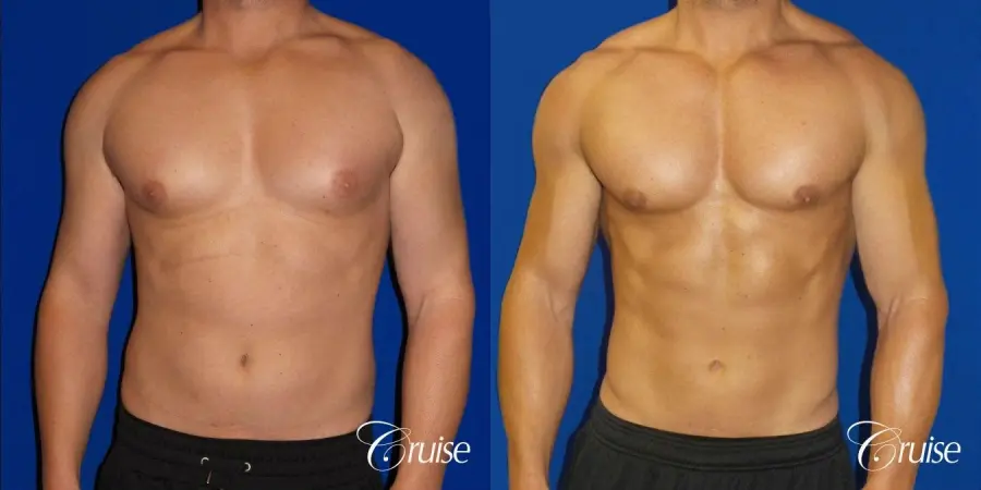 Gynecomastia puffy nipples cost - Before and After 1