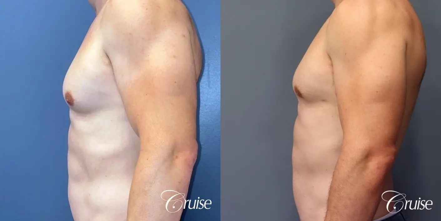 Gynecomastia: Patient 146 - Before and After 3