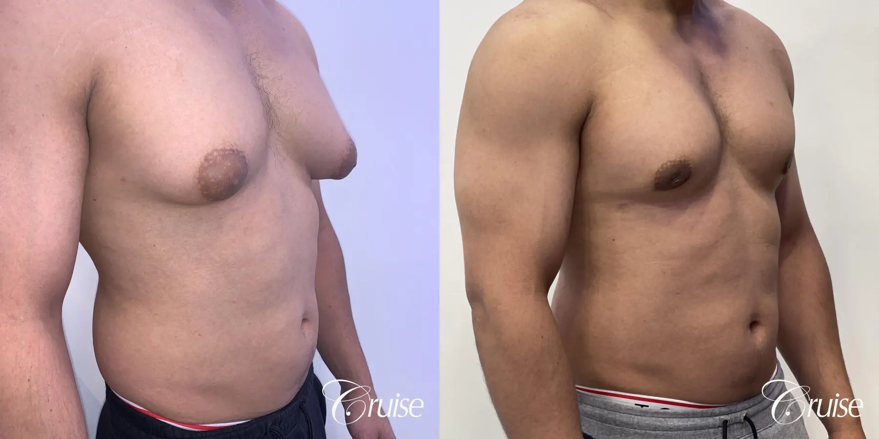 gynecomastia surgery - Before and After 5