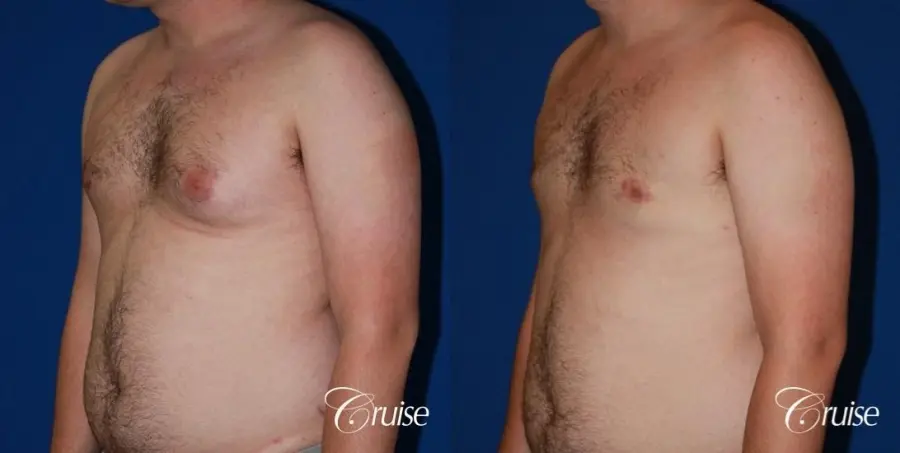 asymmetric gynecomastia moderate - Before and After 2
