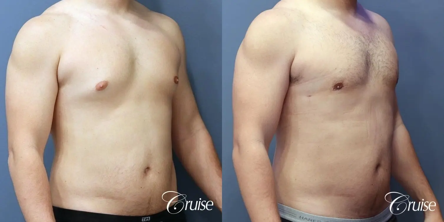Gynecomastia: Patient 151 - Before and After 4