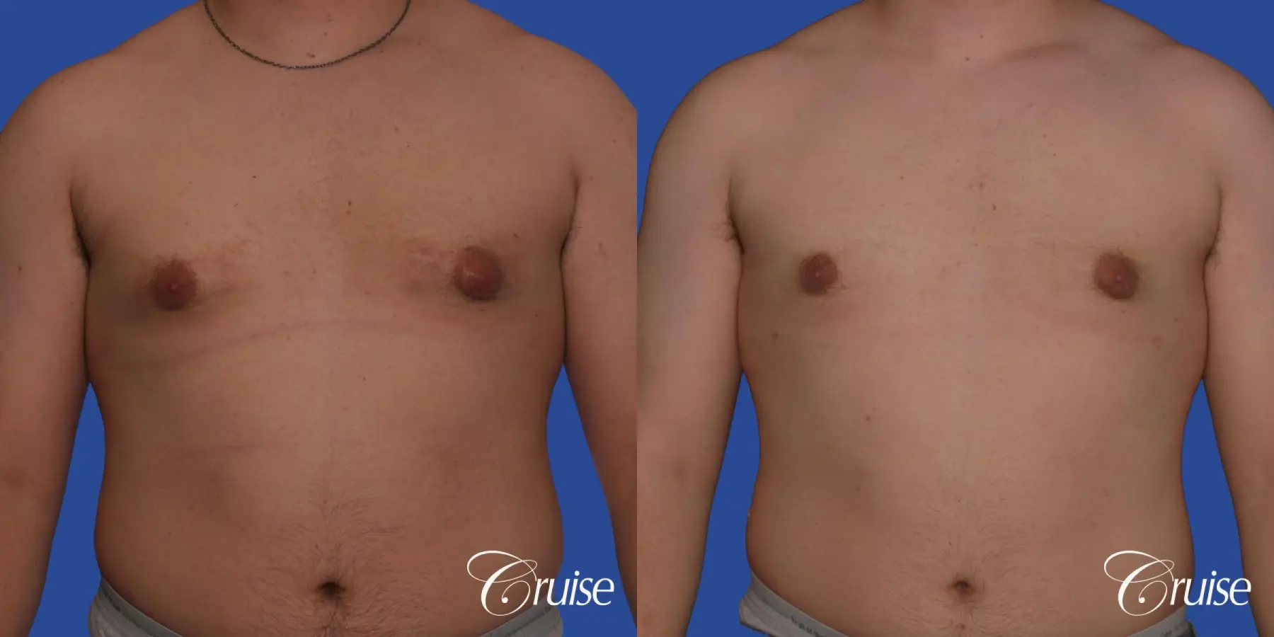 best scars for moderate gynecomastia - Before and After 1