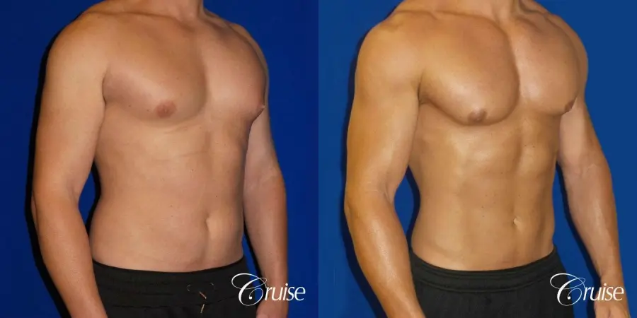 Gynecomastia puffy nipples cost - Before and After 2
