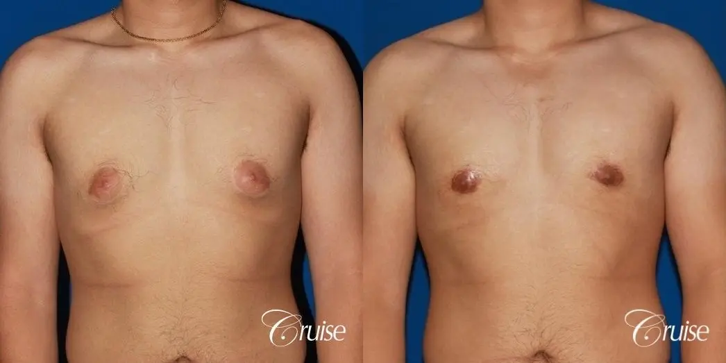 puffy nipple male breast on young adult - Before and After 1