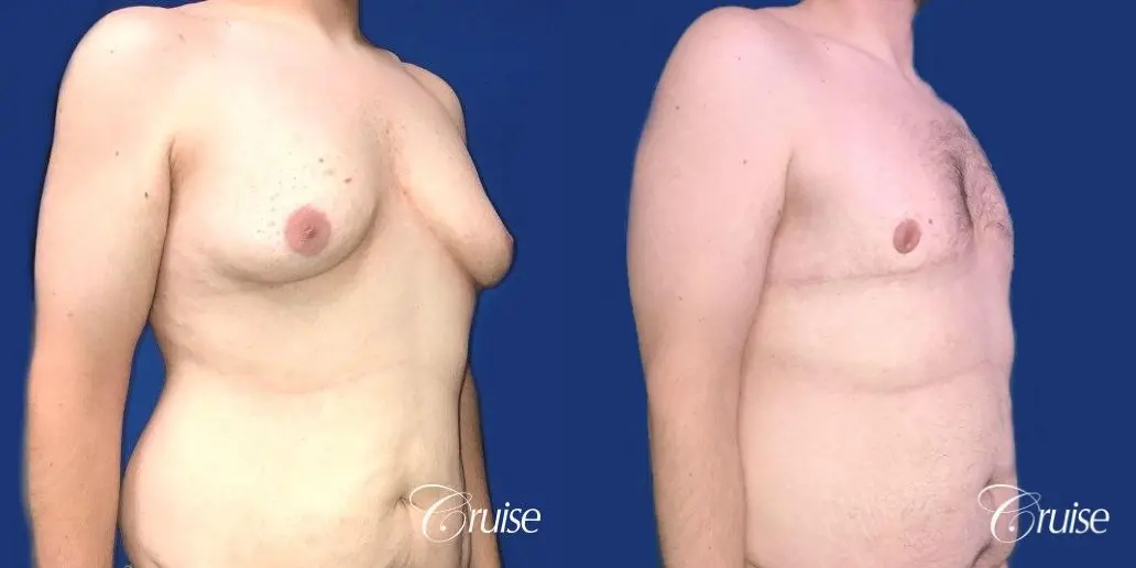 Pedicle incision Dr. Cruise Newport Beach CA - Before and After 5