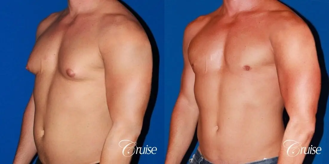 body builder with Gynecomastia puffy nipple - Before and After 3