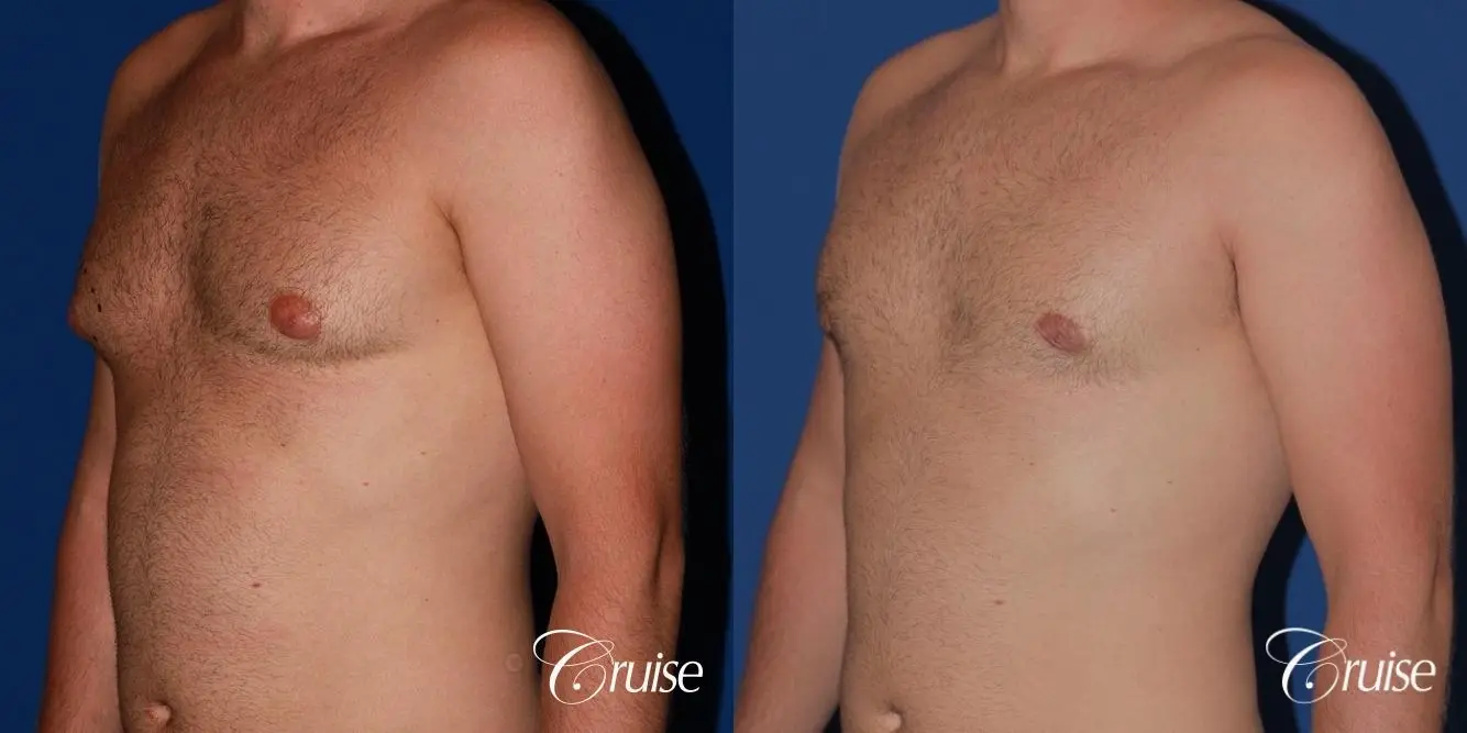 best puffy nipple surgery correction - Before and After 3