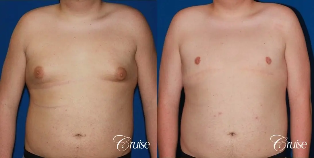 moderate gynecomastia with free nipple graft scar on teenager - Before and After 1