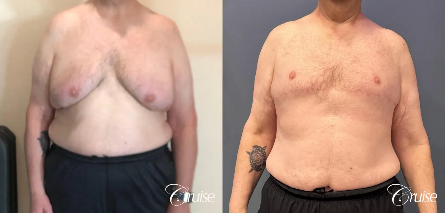 Gynecomastia Type 6; Circumferential Upper Body Lift; Liposuction to Upper Abdominal Rib Fat, Posterior Arms, Upper Back and Flanks - Before and After  