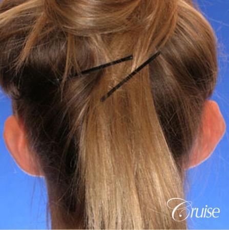 best otoplasty photos by top plastic surgeon - Before and After Image 4