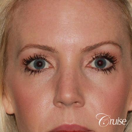 best upper eye lid results - After Image 1