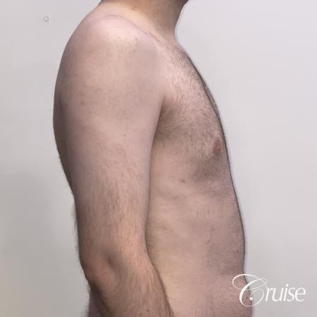 Gynecomastia: Patient 128 - After 4