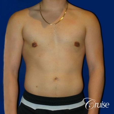 Best Gynecomastia surgeons Southern California - After Image 1